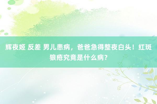 辉夜姬 反差 男儿患病，爸爸急得整夜白头！红斑狼疮究竟是什么病？